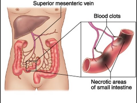 Video: Mesenteric Artery Thrombosis - Symptoms And Treatment