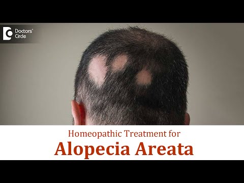 Patchy hair loss ( Alopecia Areata) | Causes, Symptoms & Homeopathic Treatment - Dr. Surekha Tiwari