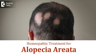 Patchy hair loss ( Alopecia Areata) | Causes, Symptoms & Homeopathic Treatment - Dr. Surekha Tiwari