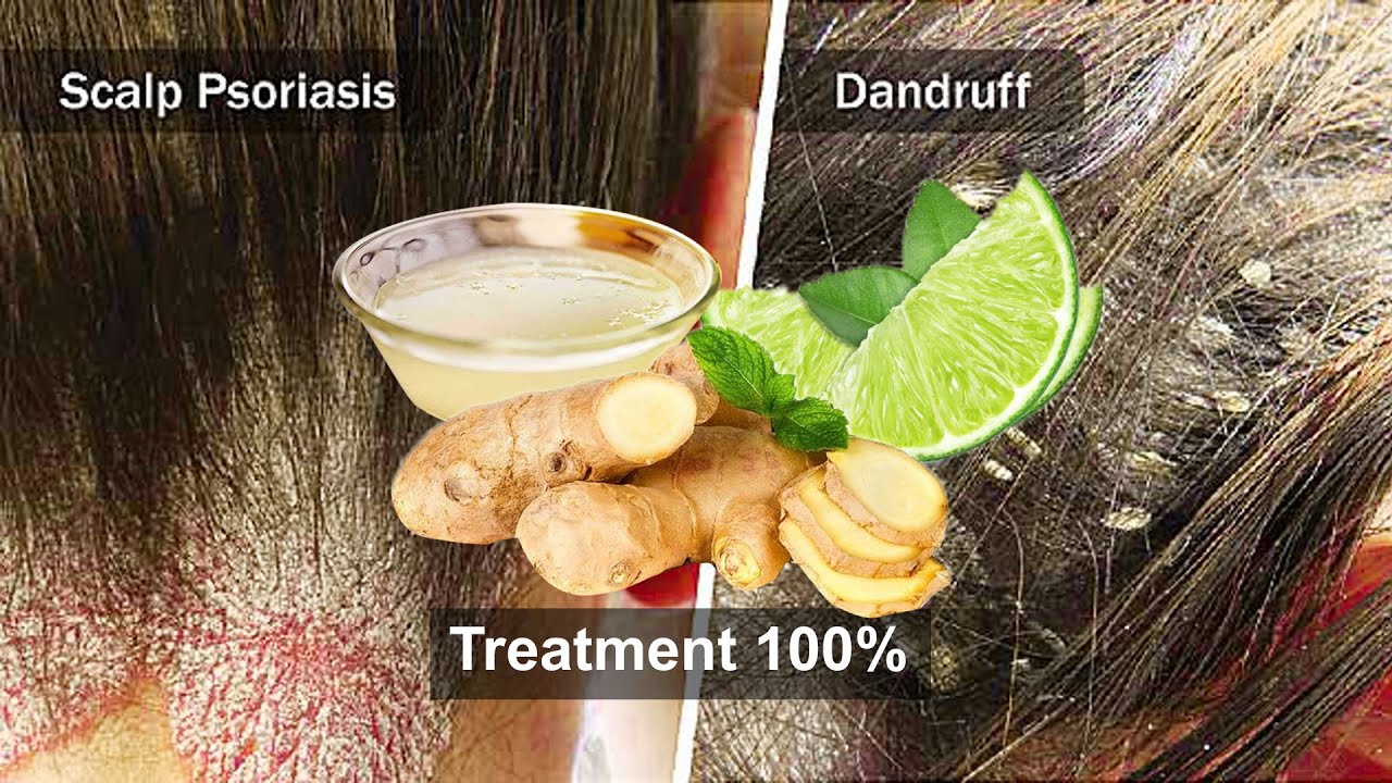 ginger psoriasis