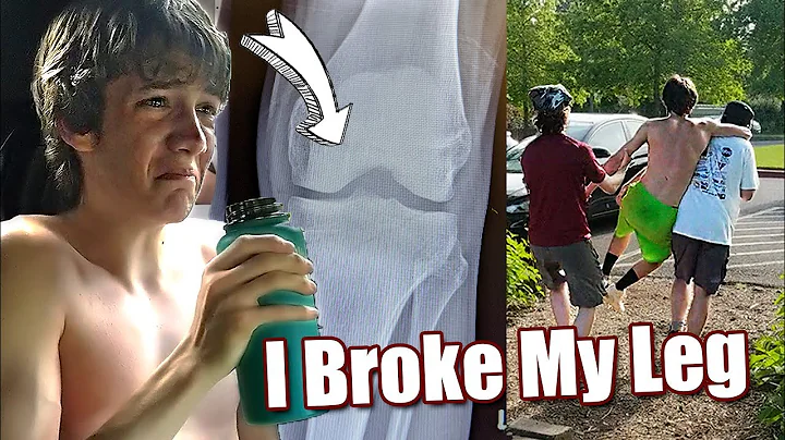 I Broke My Leg!