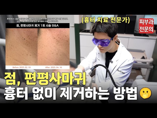 흉터 없이 편평사마귀, 점 없애는 방법 최초 공개!ㅣ점 없애는 법, 점 빼고 관리, 점 빼는 영상, 점 빼고 후기, 편평사마귀 제거, 편평사마귀 레이저, 편평사마귀 제거 후기