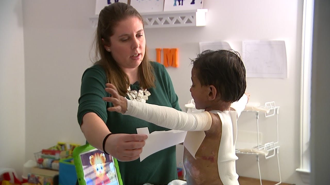Butterfly child Rare skin disorder affects Chapel Hill 4yearold