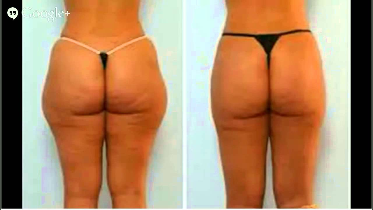 What are the average results for thigh liposuction?