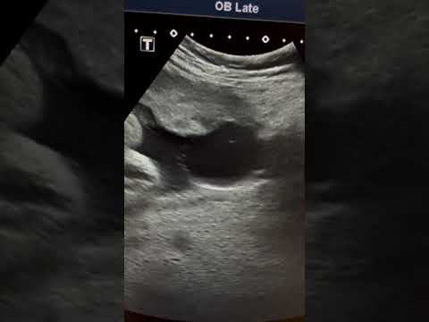 Placental cyst Ultrasound