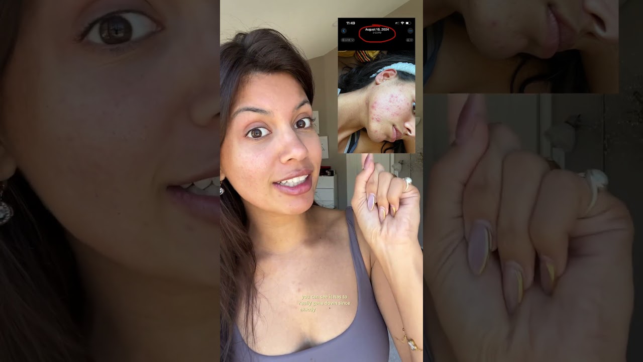 Viral LED Mask - Great for fighting acne, inflammation and fine lines