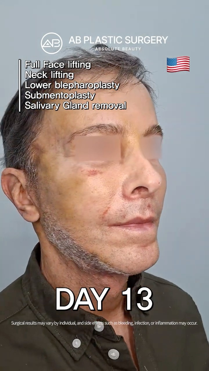 NeckLift UpperBlepharoplasty Took Years Off ✨ #shorts