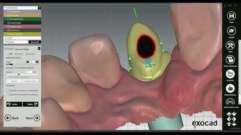 How to design a Custom Abutment in #exocad