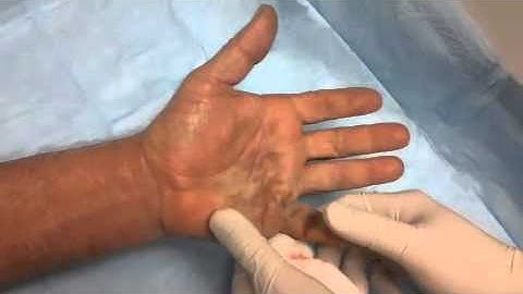 Forced Extension 2 Days After Xiaflex Treatment (Dr. Kenty Sian/Fresno Plastic Surgery)