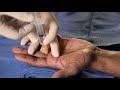 Peripheral Nerve Blocks for Hand Procedures