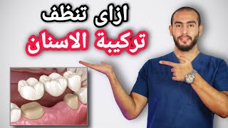 تعليمات بعد تركيب الاسنان الثابتة | افضل طريقة للتنظيف تحت وحول تركيبة الاسنان الثابتة (الكوبرى)🦷🥳