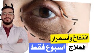 العلاج المضمون والنهائي .. للهلات السودا وانتفاخ العين .. في اسبوع فقط