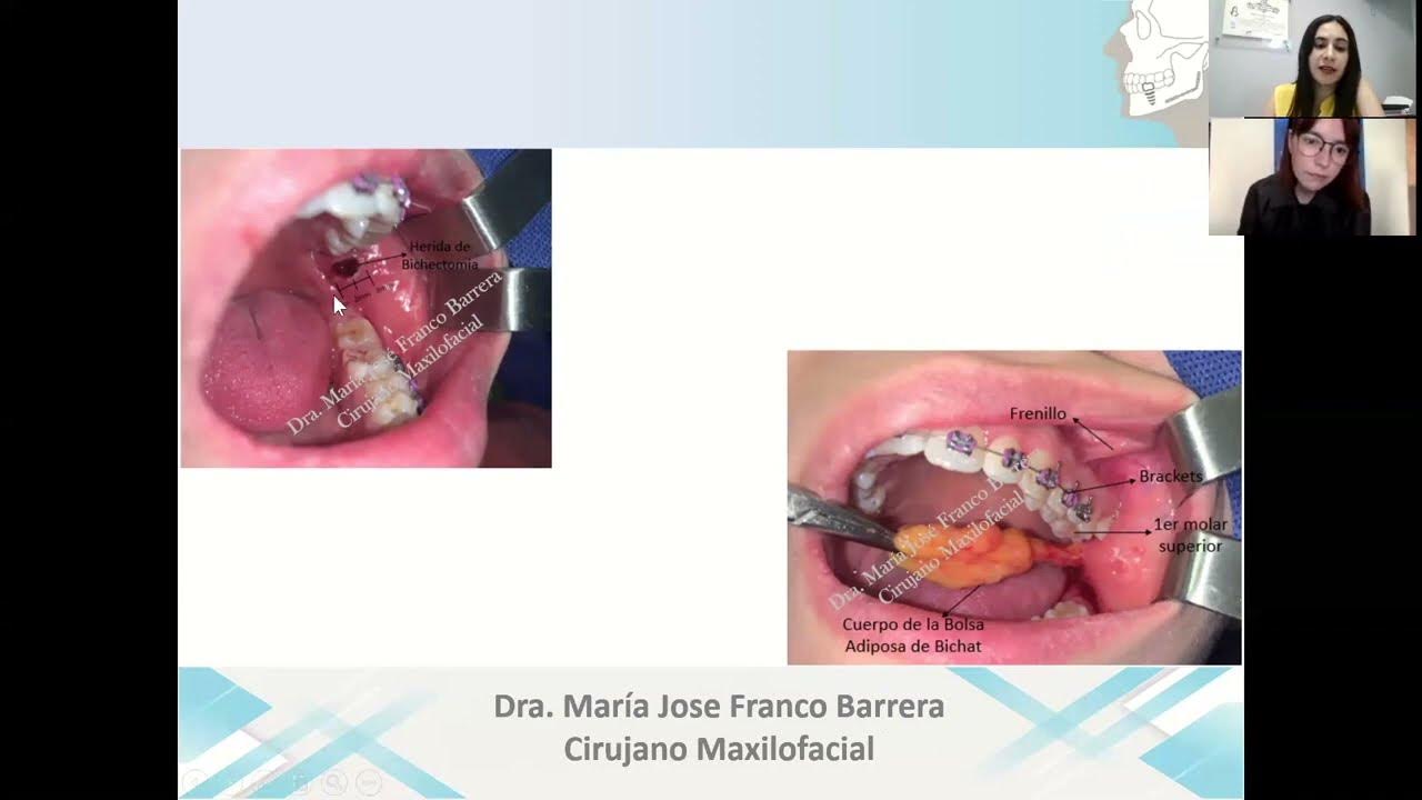 BICHECTOMÍA paso a paso + Cuidados postoperatorios YouTube