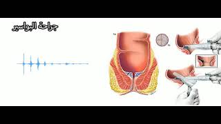 تجربتي مع عملية البواسير