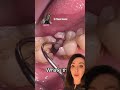 Gum Over Grown Due To Cavity!