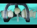 Post Cementation and Core Build-Up Using LuxaCore Z Dual