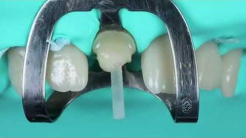 Post Cementation and Core Build-Up Using LuxaCore Z Dual