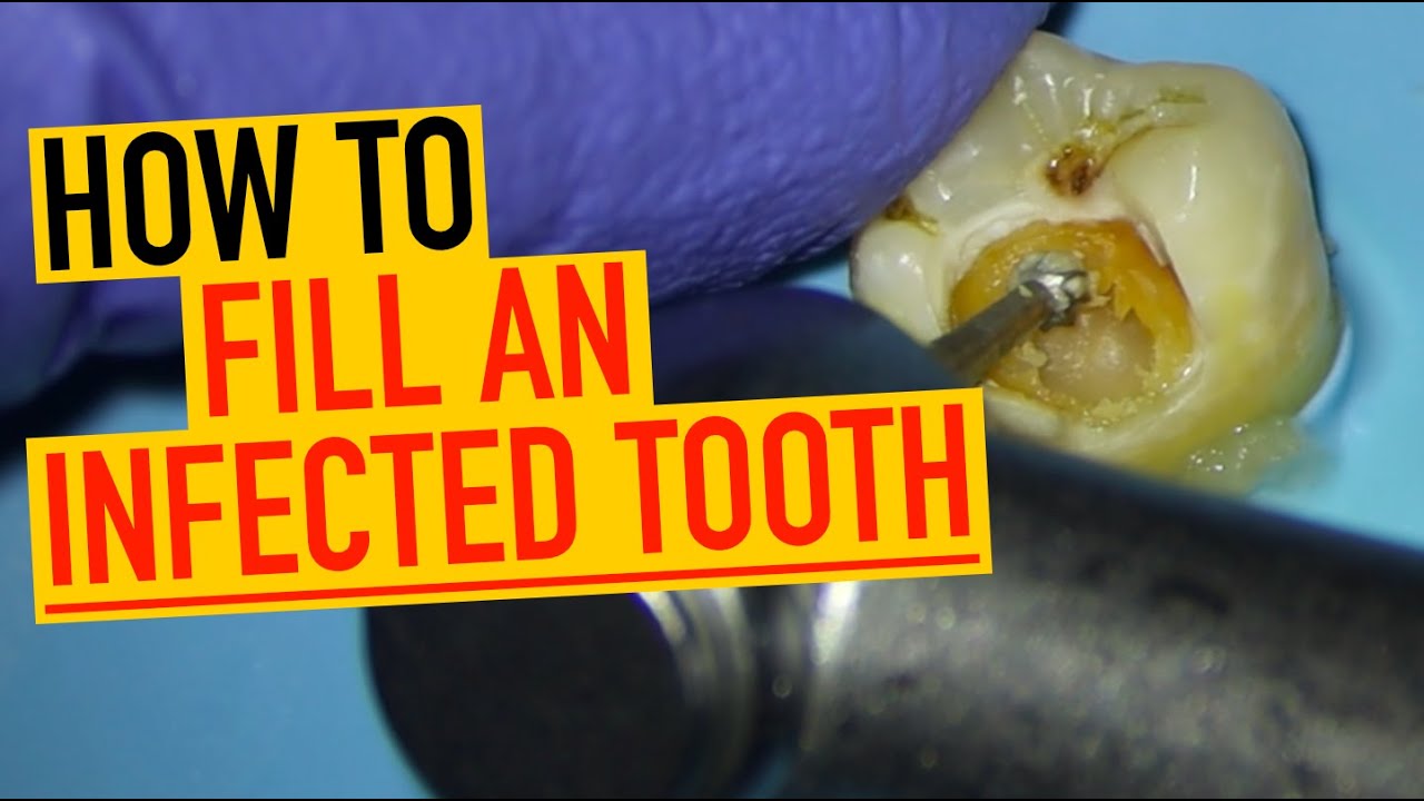 You’re Probably Dressing Teeth Wrong Before RCT… Here’s Why - YouTube