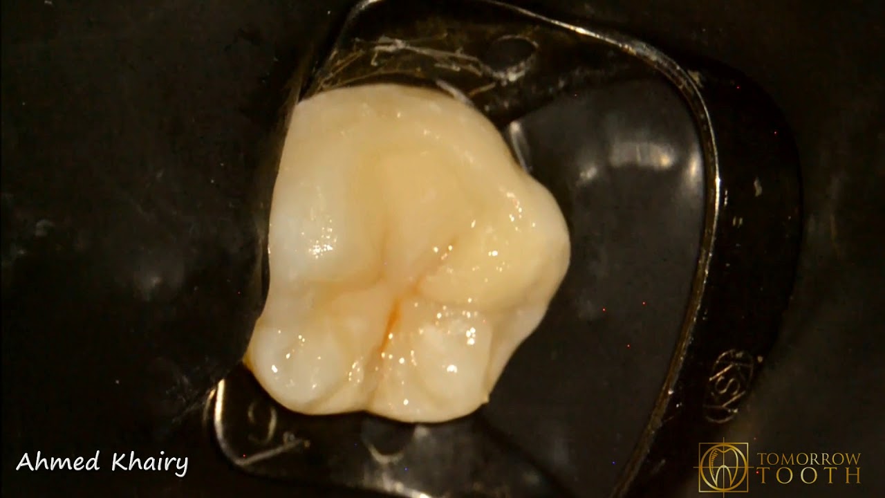 How to create Esthetic Composite restoration YouTube