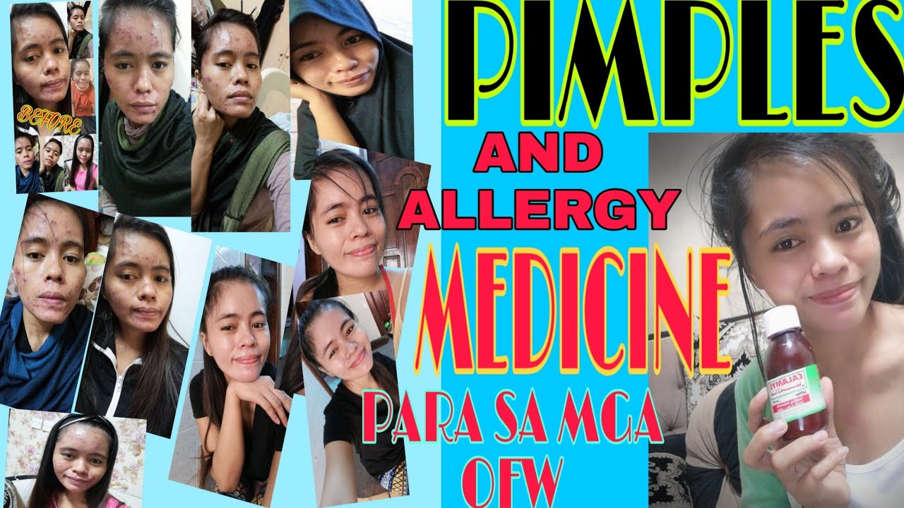 PAANO MAWALA ANG PIMPLES OR ALLERGY - YouTube