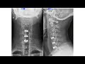 Degenerative Cervical Spine: Diagnosis and Management