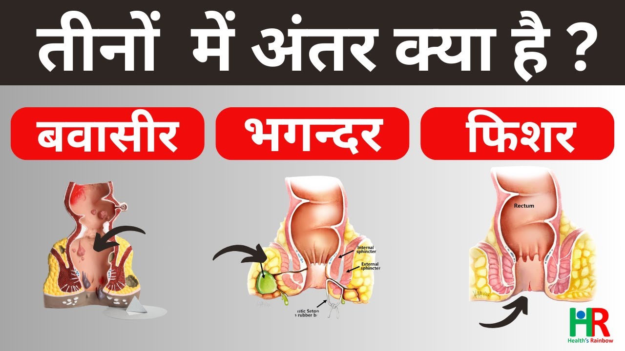 बवासीर, फिशर, भगन्दर में क्या अंतर है ? Difference between Piles, fissure and fistula in hindi