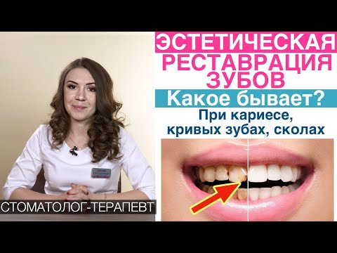 Эстетическая реставрация передних зубов, композитный (пломбировочный) материал, винирами.Кариес,щель