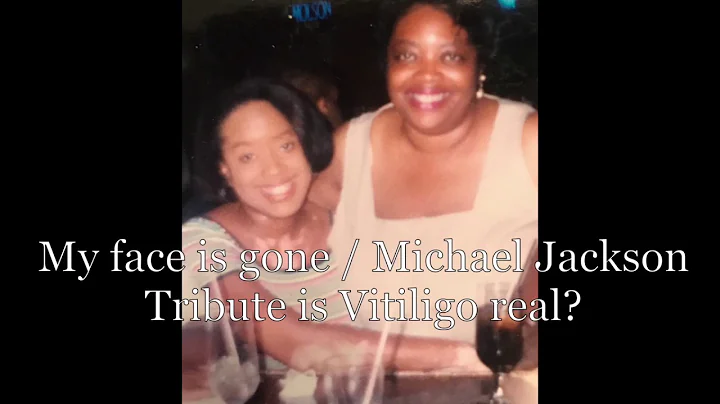 Vitiligo Story #7: My face is gone/ Michael Jackso...