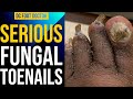 Serious Fungal Toenails: Helping Those Who Can't Help Themselves