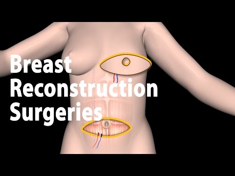 Breast Reconstruction Surgery after Mastectomy: TRAM, DIEP, SIEA flaps.