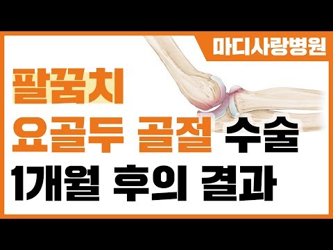 [팔꿈치 수술 결과] 팔꿈치 요골두 골절 수술 1개월 후의 결과 / 팔꿈치 수술