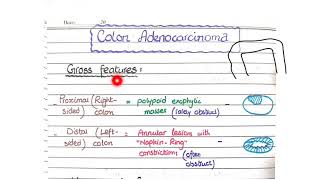 Colon Adenocarcinoma ; Morphology