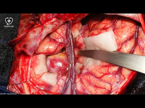 Was ist eine Hirnblutung? Wie behandelt man ein Aneurysma im Kopf?
