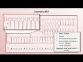 Intro to EKG Interpretation - Practicing Tachyarrhythmia Identification