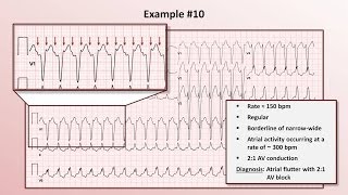 Intro to EKG Interpretation - Practicing Tachyarrhythmia Identification