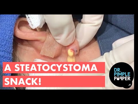 A Steatocystoma Snack!