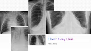 Chest X-ray Quiz: Atelectasis