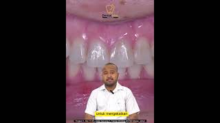 Apa Itu Gigi Palsu Flexible