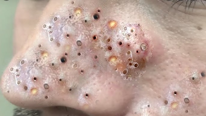 Big Cystic Acne Blackheads Extraction Blackheads & Milia, Whiteheads  Removal Pimple Popping # 3677 - YouTube