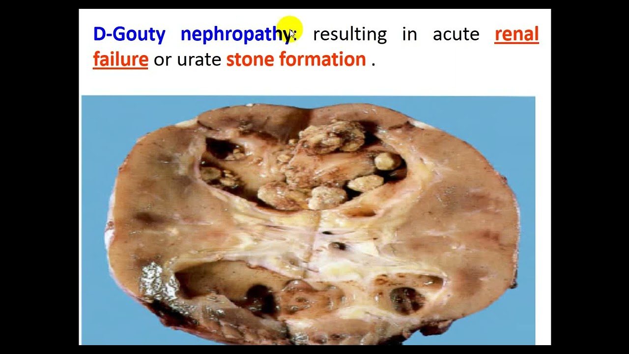 GOUT 2024 By Dr  Dheyaa Jabbar