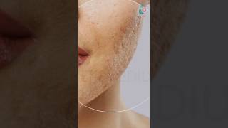 Punch Graft Acne Scar Treatments ↪ 3D Medical Animation #Skin #PunchGrafting #Shorts
