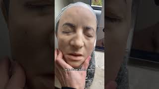#врачкосметолог #акне #брыли