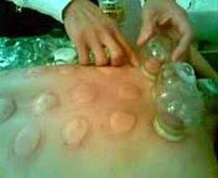 Chinese cupping therapy with Andrea (3)