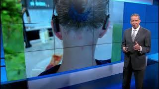 Hudson Valley parents: Peculiar black fly bites a new concern