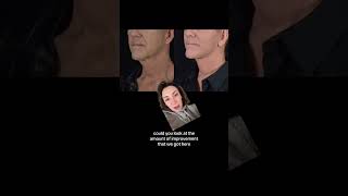 Male Facelift