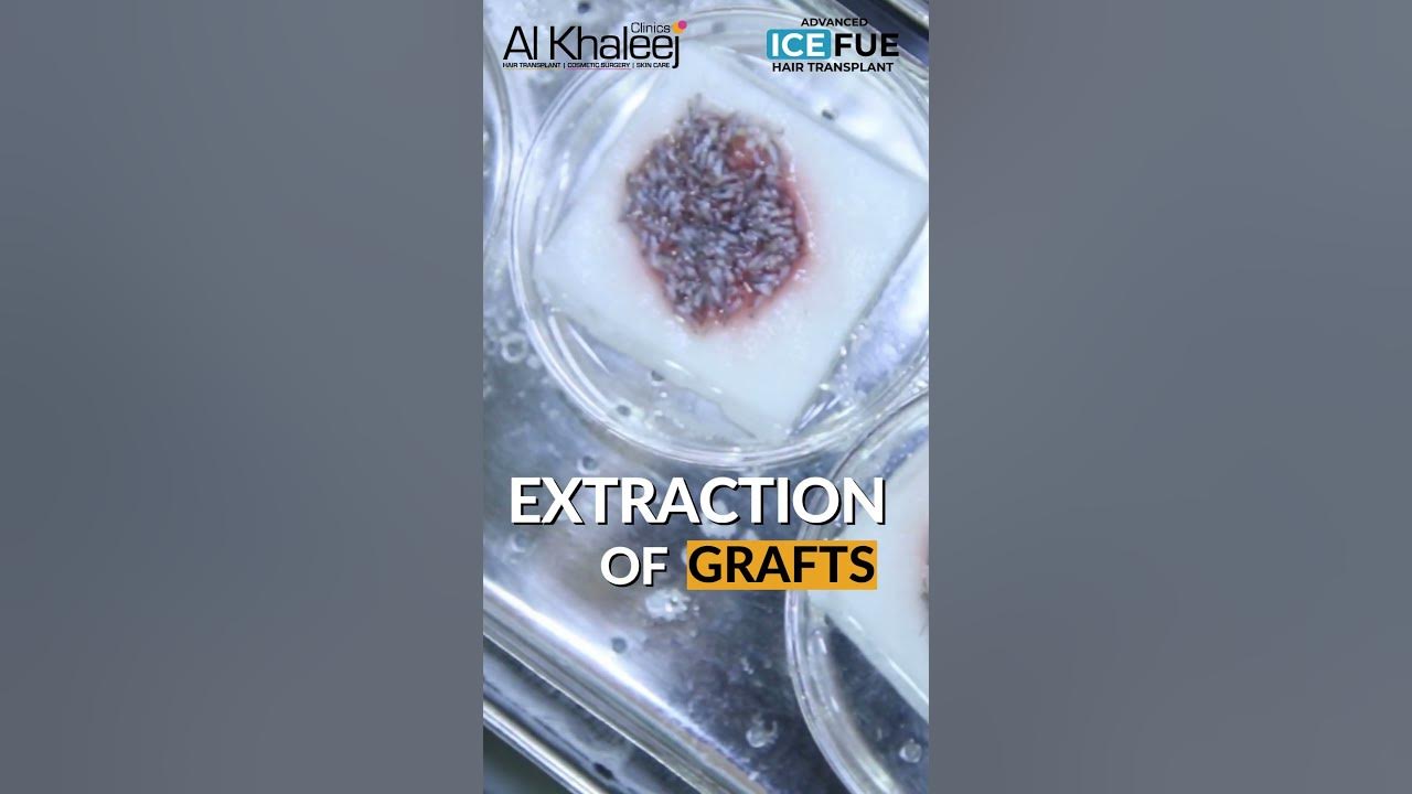 extraction-of-grafts-ice-fue-hair-transplant-alkhaleej-clinics
