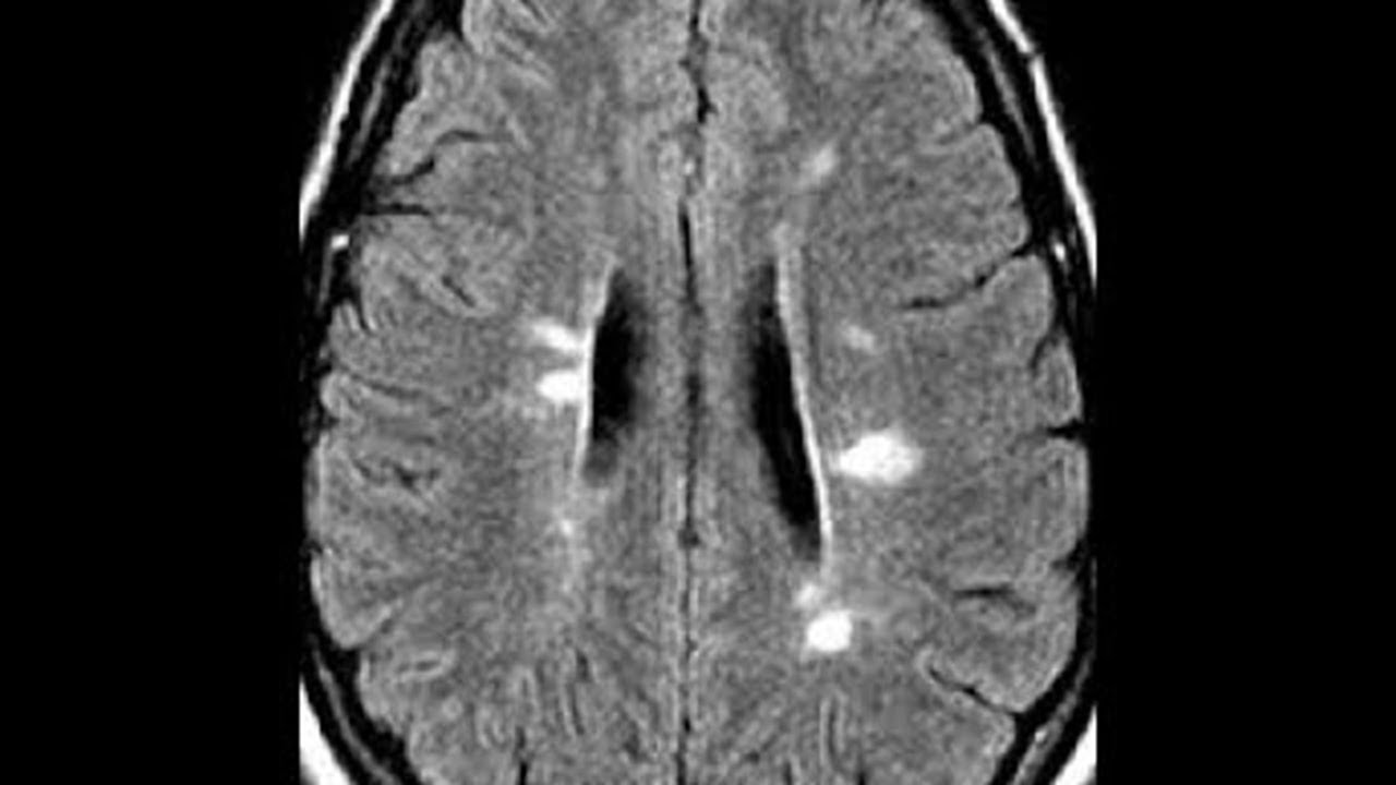 ¿Qué es la Esclerosis Múltiple?