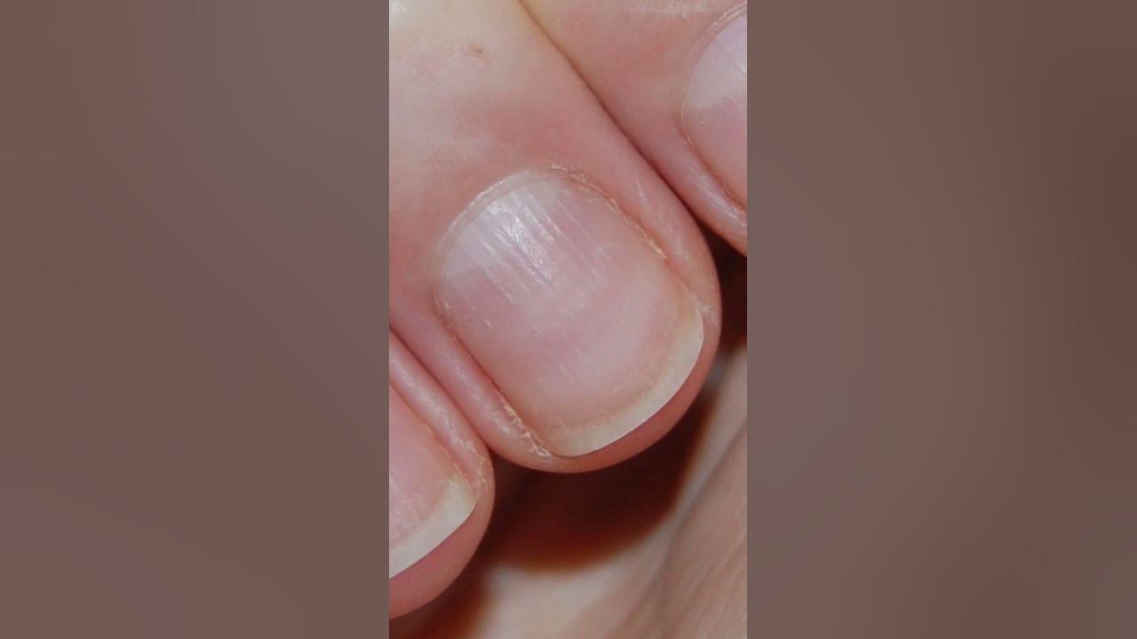 Ребристые ногти причина у мужчин