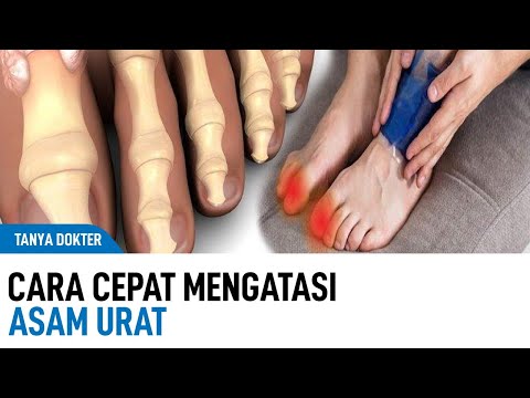 Video: 3 Cara Meringankan Sakit Gout di Jari Anda