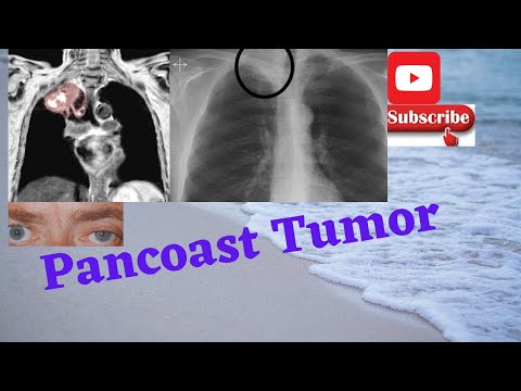 PANCOAST Tumor-What are the symptoms?Where does Pancoast tumor hurt? usmle, neetpg, plab, fmge.